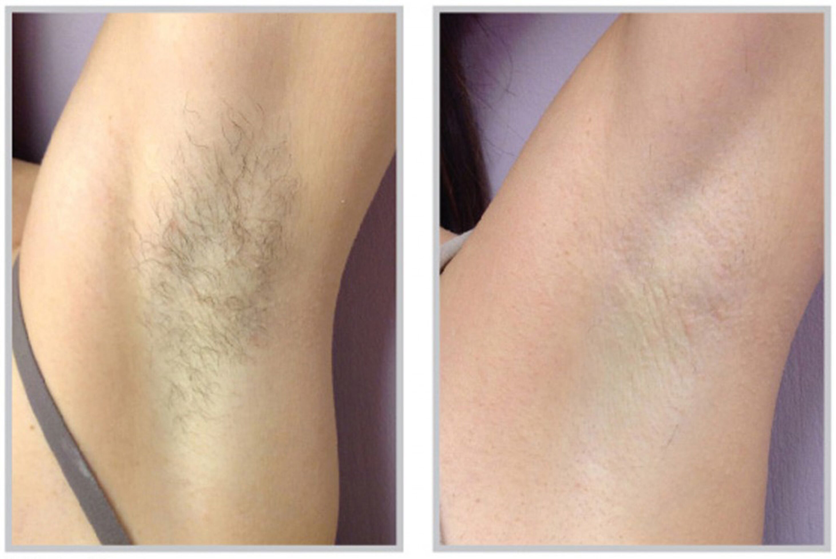 New Technology Ipl Shr Epilator Opt Hair Removal Equipment New Technology Ipl Shr Epilator Opt Hair Removal Equipment