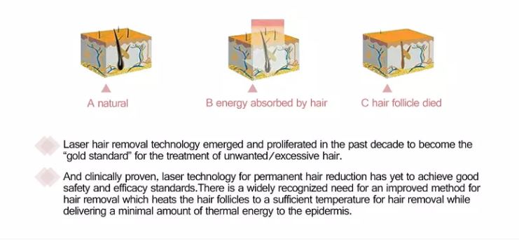 Pain Free Laser Hair Removal Machine Pain Free Laser Hair Removal Machine