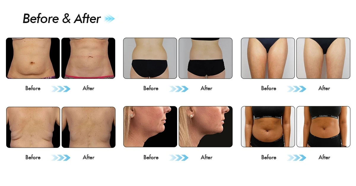 Cryo Lipolysis Vacuum Fat Freezing Slimming Device Cavitation Rf Lipo Laser Multifunction Salon Beauty Cryo Lipolysis Vacuum Fat Freezing Slimming Device Cavitation Rf Lipo Laser Multifunction Salon Beauty